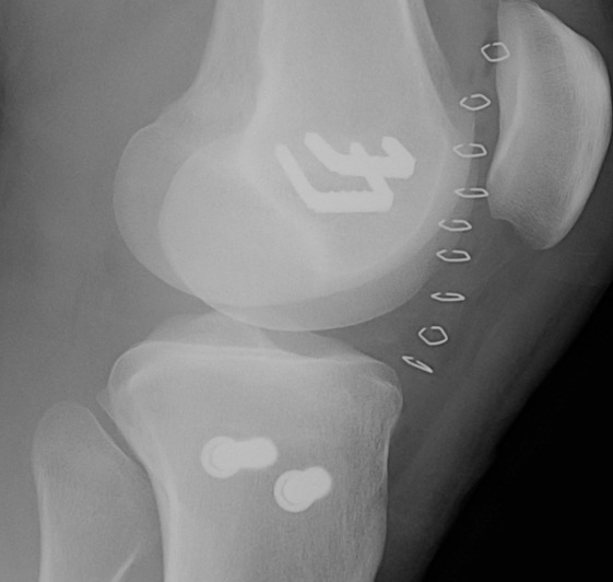 MCL Bony Avulsion ORIF Lateral